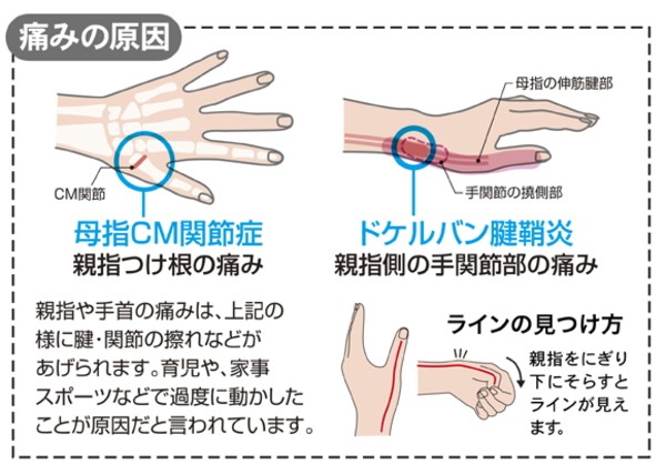 拇指CM関節症：親指の付け根の痛み・親指や手首の痛みは上記のように腱、関節の擦れなどがあげられます。育児や、家事、スポーツなどで過度に動かしたことが原因だと言われています。ドゲルバン腱鞘炎：親指側の手関節の痛み…ラインの見つけ方…親指をにぎり下にそらすとラインが見えます