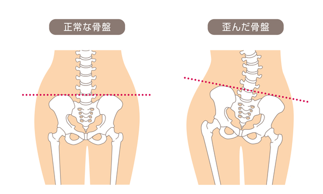 ウエストの左右のカーブが違うのは骨盤の歪みや骨盤バランスが原因 志木駅近くの整体 産後の骨盤矯正ならイーバランス整体院