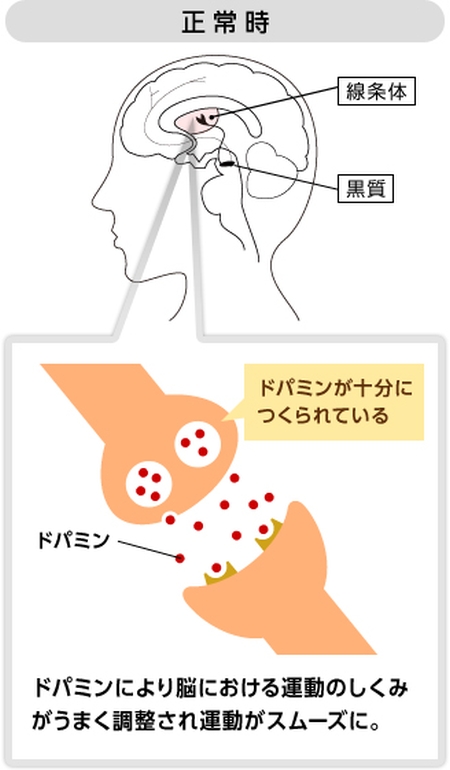 パーキンソン病-2