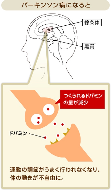 パーキンソン病-3
