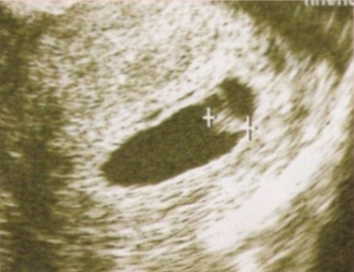 妊娠５週画像