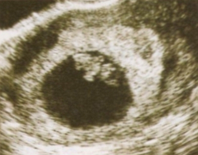 妊娠７週画像