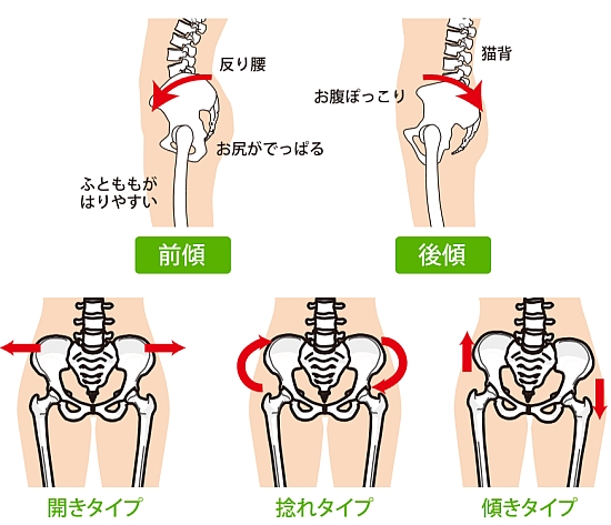産後は骨盤が前傾、後傾、ねじれ、傾き、広がりの歪み