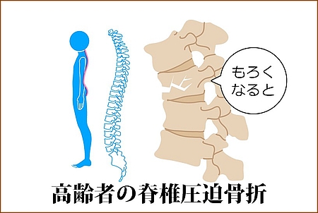 高齢者の脊椎圧迫骨折