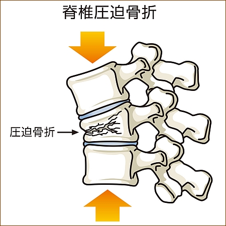 高齢者の脊椎圧迫骨折の原因