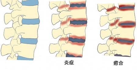 背骨のリュウマチ!強直性脊椎炎の症状と、その対処方法とは?