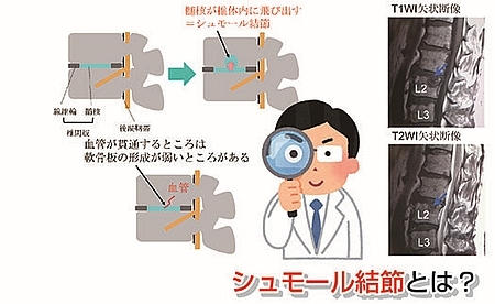 シュモール結節