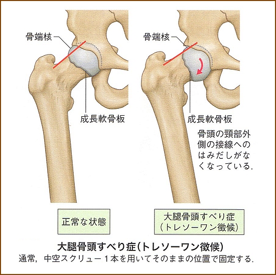 大腿骨すべり症の検査方法、診断方法