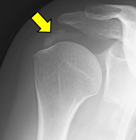 石灰腱炎の単純X線写真