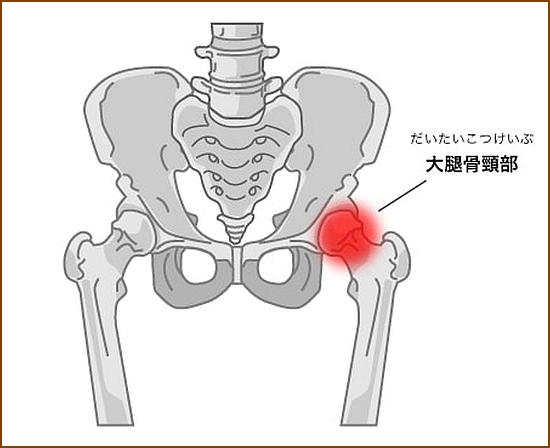 股関節脱臼の痛み