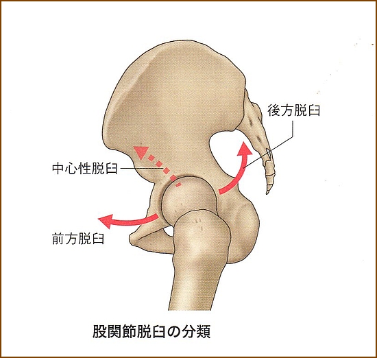 股関節脱臼の分類