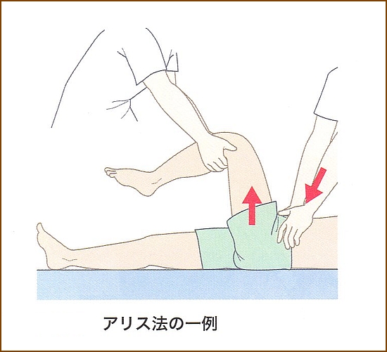 股関節脱臼の治療方法