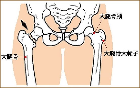 股関節脱臼の合併症・大腿骨骨折