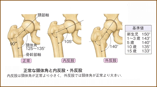 大腿骨骨幹部と大腿骨頸部とのなす角度を頚体角