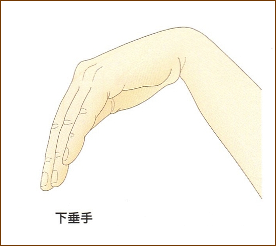 橈骨神経麻痺の下垂手
