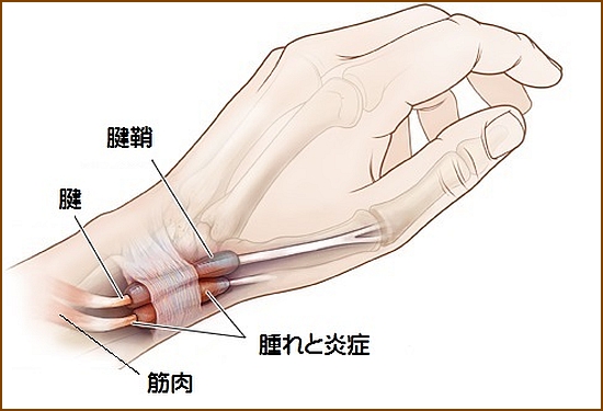 狭窄性腱鞘炎（ドケルバン病、ばね指）の原因