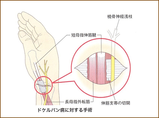 ドケルバン病、ばね指の治療方法1