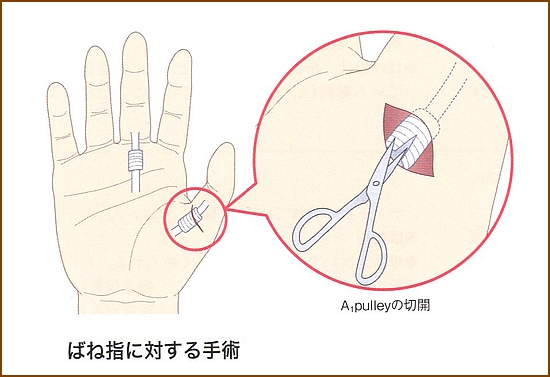 ドケルバン病、ばね指の治療方法2