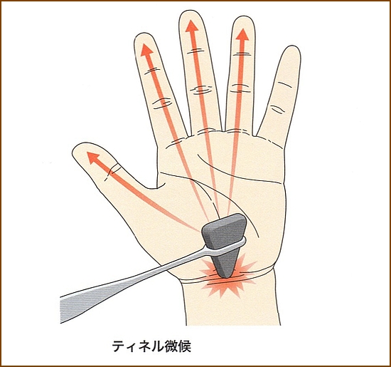 ティネル兆候