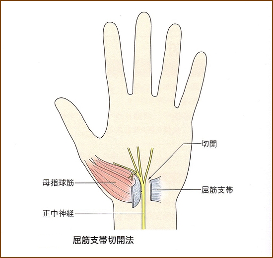 手根管症候群の治療方法
