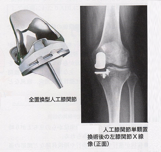 変形性膝関節症の治療方法