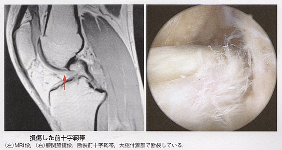膝関節の靭帯損傷の検査方法