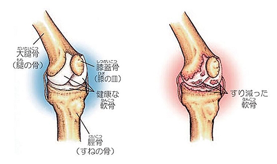 膝の痛みを改善