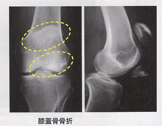 膝蓋骨骨折
