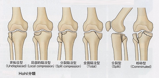 脛骨近位端骨折のhohl分類