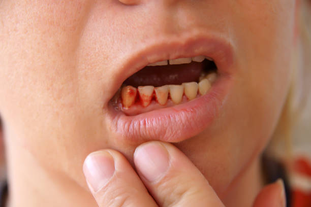 妊娠中の歯茎の出血