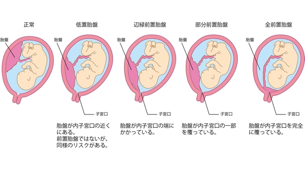 星状胎盤と前置胎盤