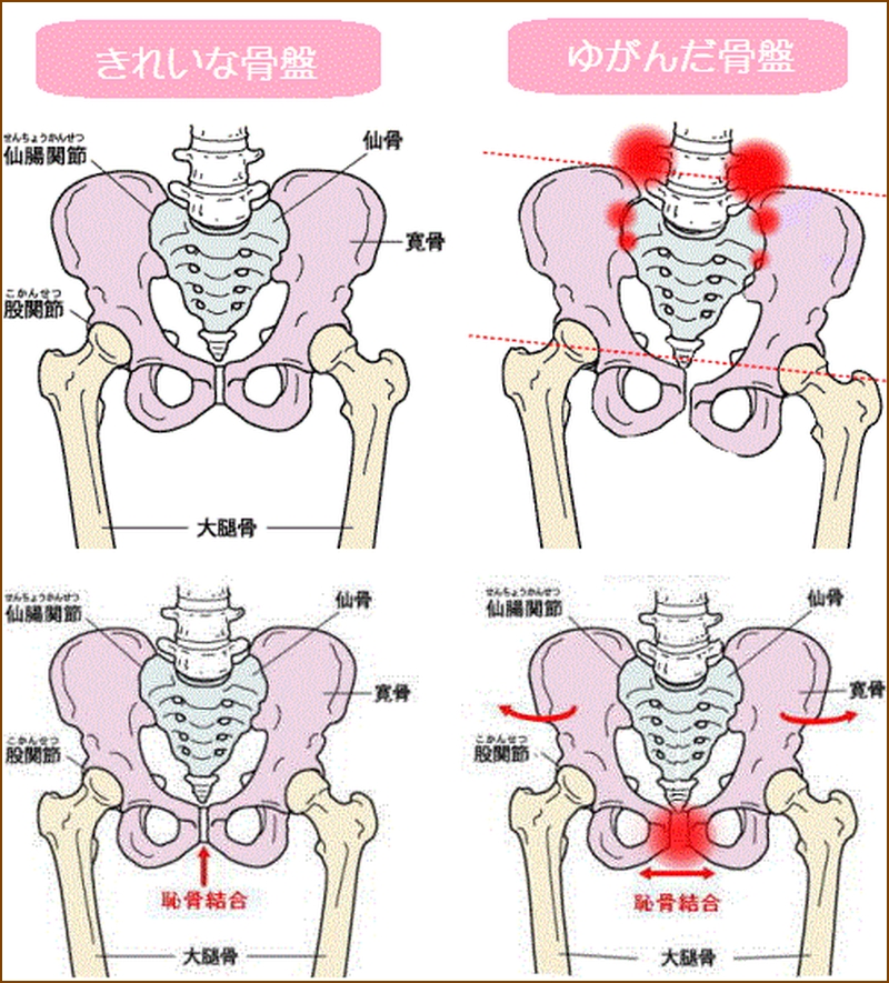 骨盤の歪み方