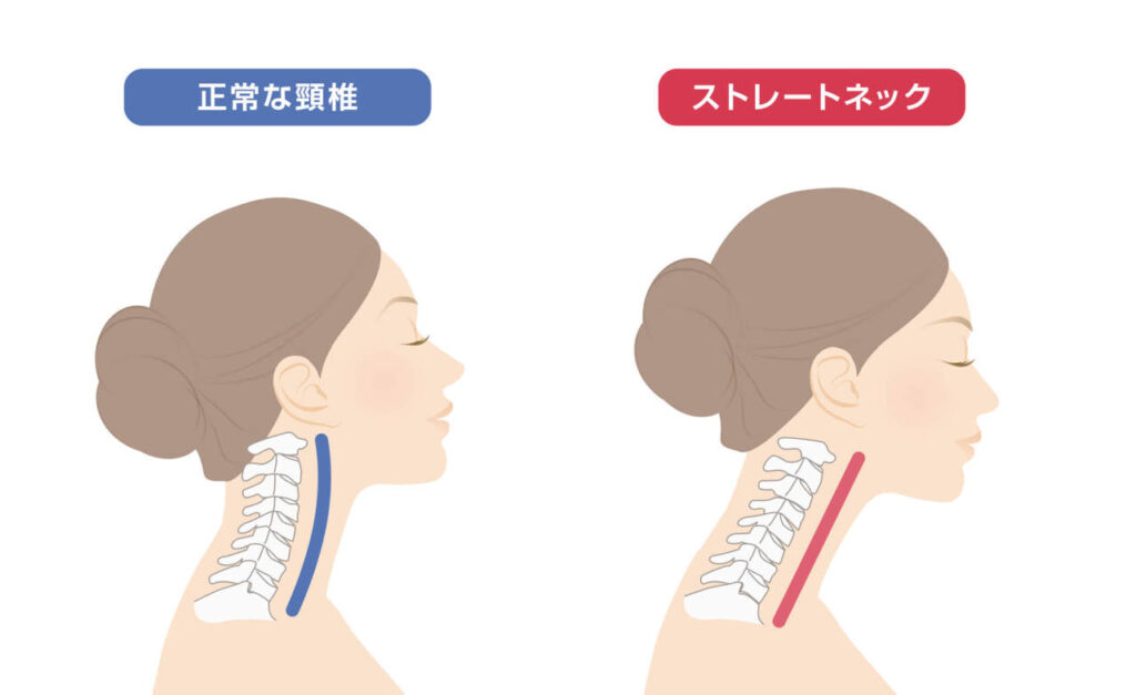 頚椎がまっすぐ