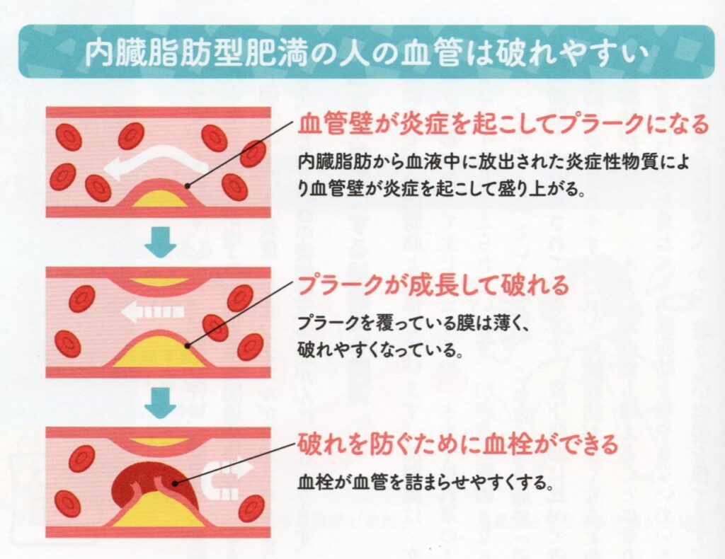 内臓脂肪は血管を傷つける