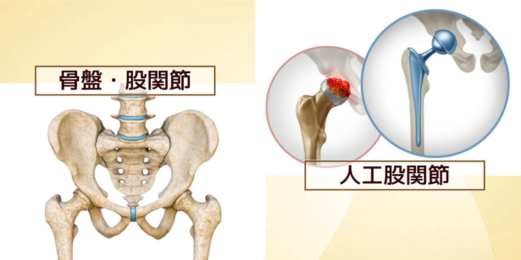 股関節痛、変形性股関節症