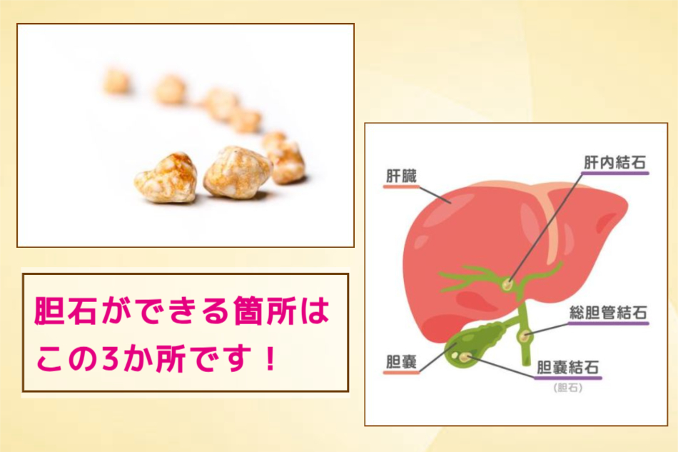 胆石ができやすい3か所