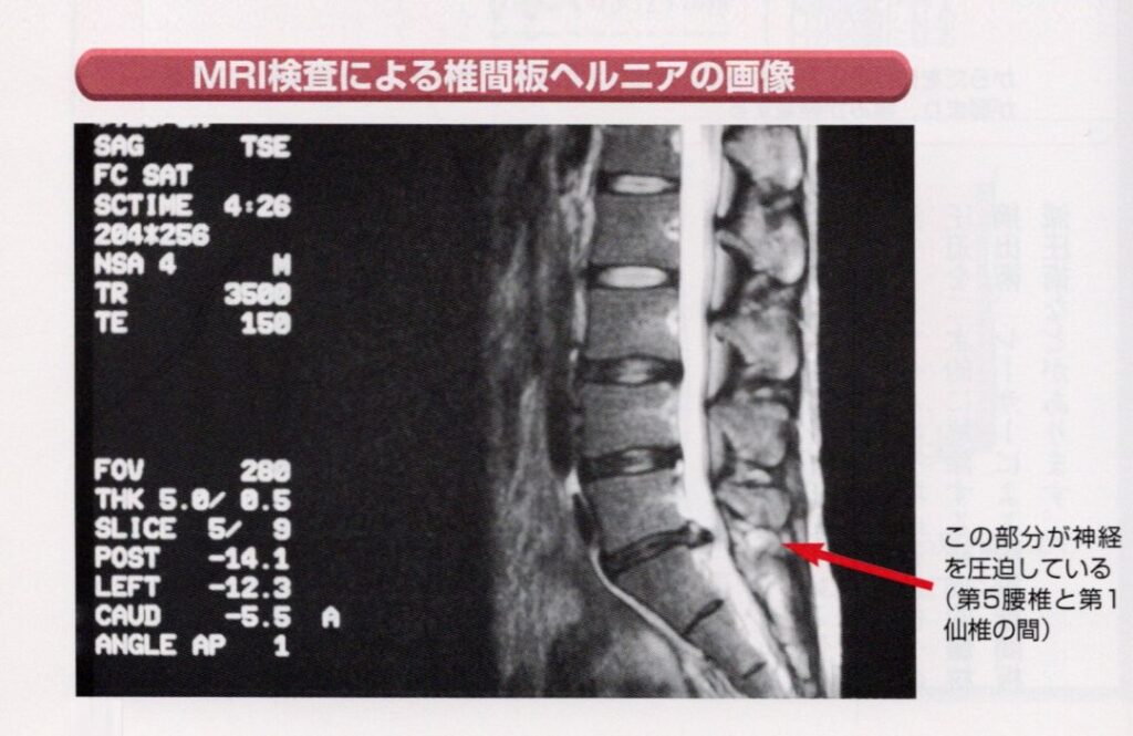 ヘルニアの画像診断