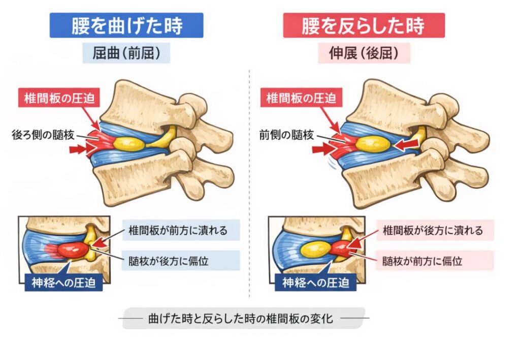 腰を曲げた時と伸ばした時の椎間板の状態