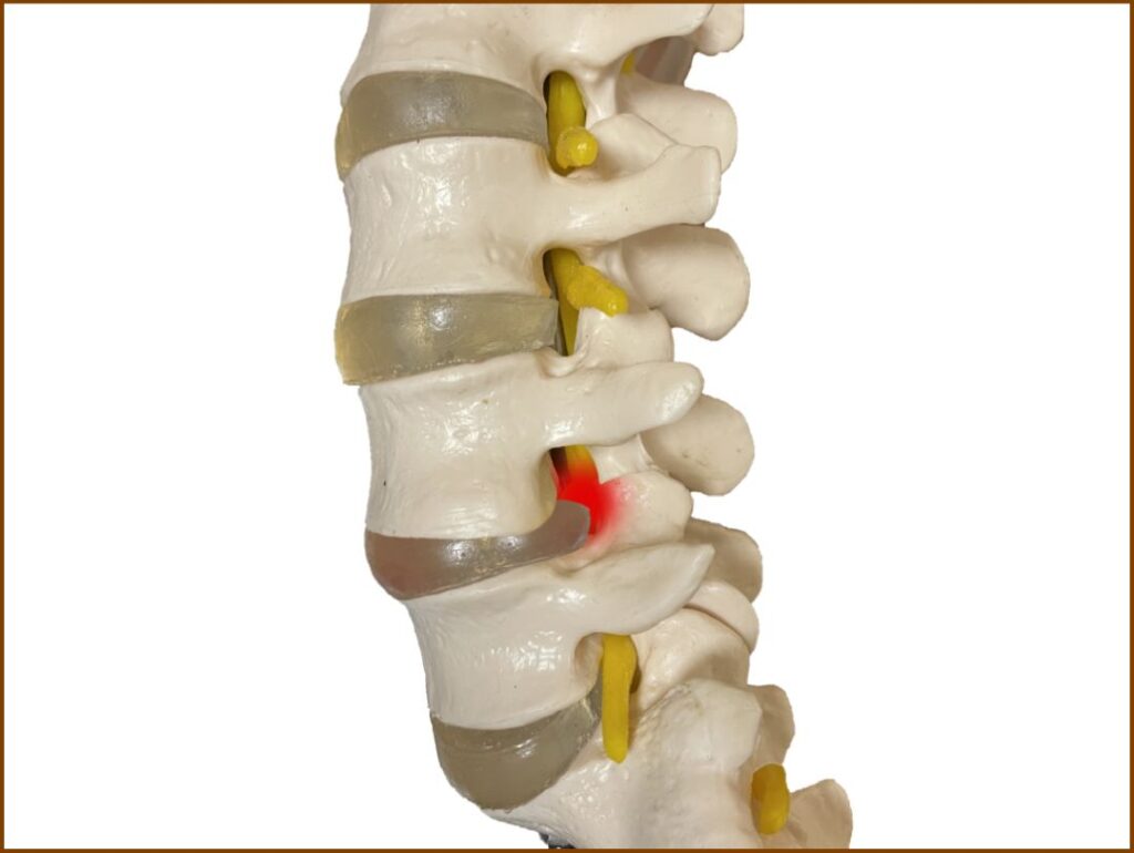 椎間板ヘルニア