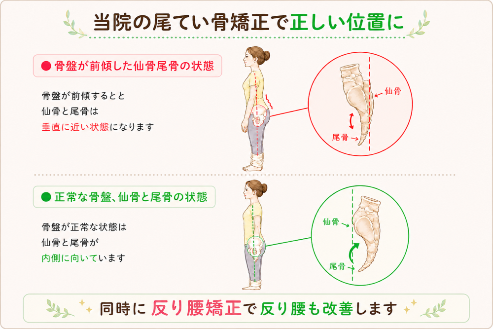 当院の尾てい骨矯正で正しい位置に●骨盤が前傾した仙骨尾骨の状態 骨盤が前傾すると仙骨と尾骨は垂直に近い状態になります●正常な骨盤、仙骨と尾骨の状態 骨盤が正常な状態は仙骨と尾骨が内側に向いています同時に反り腰矯正で反り腰も矯正します